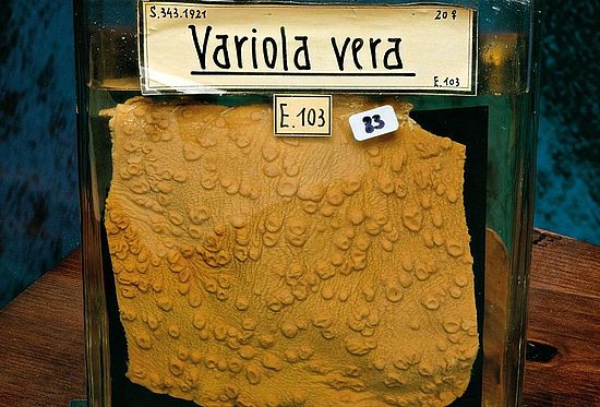 Variola vera